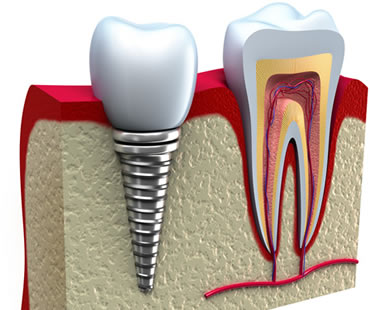 dental implants dentist in Woolwich