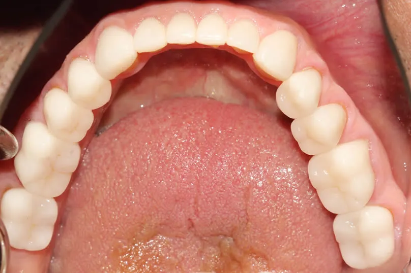 Restoring Severe Tooth Wear with Full Crown Reconstruction - bottom teeth after
