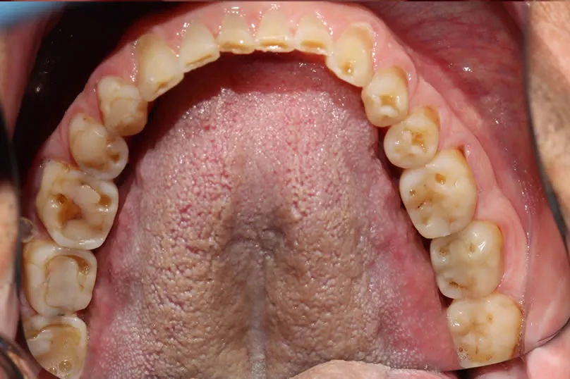 Restoring Severe Tooth Wear with Full Crown Reconstruction - bottom teeth before