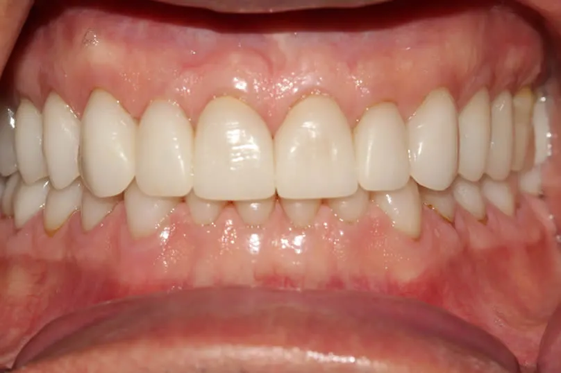 Restoring Severe Tooth Wear with Full Crown Reconstruction - front teeth after
