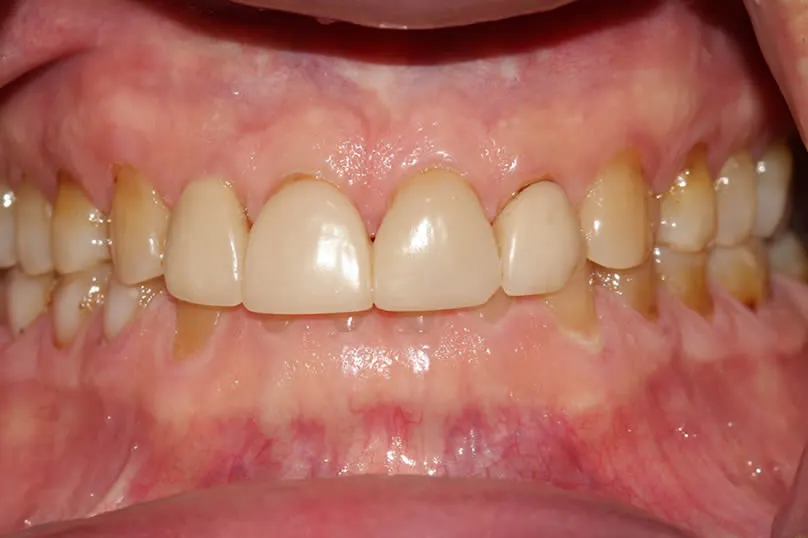Restoring Severe Tooth Wear with Full Crown Reconstruction - front teeth before