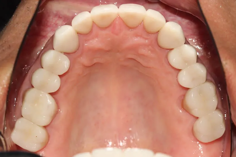 Restoring Severe Tooth Wear with Full Crown Reconstruction - upper teeth after