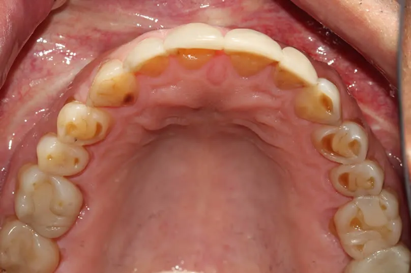 Restoring Severe Tooth Wear with Full Crown Reconstruction - upper teeth before