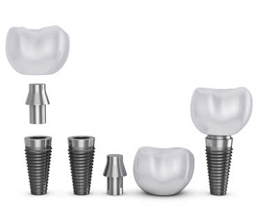 Dental Implant FAQ